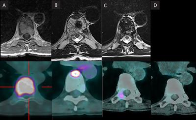 Re-irradiation of recurrent vertebral metastasis after two previous spinal cord irradiation: A case report